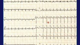 ECG Normal partie 4 [upl. by Nollad]