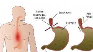 What is Esophageal Dysmotility [upl. by Yrrek]