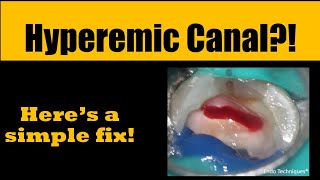 How to stop a bleeding root canal quickly [upl. by Aicsile]