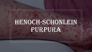 HenochSchonlein Purpura  purple rash on skin vasculitis [upl. by Nnaik]