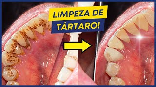 COMO É FEITA A LIMPEZA DE TÁRTARO [upl. by Oicul723]