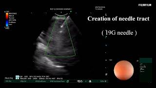 EBUS Intranodal cryobiopsy  Mediastenal Carcinoid tumor [upl. by Bohlen945]