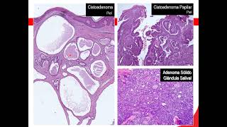 11 Neoplasias 2 A apg Neoplasias benignas epiteliales y mesenquimáticas [upl. by Nerahs]