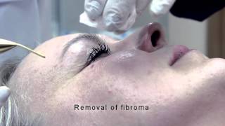 Jett Plasma Lift Medical  Removal of skin imperfections [upl. by Sammer179]