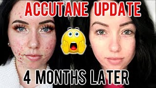 MY ACCUTANE JOURNEY 4 MONTH UPDATE Before amp After Progress Side Effects [upl. by Richter]