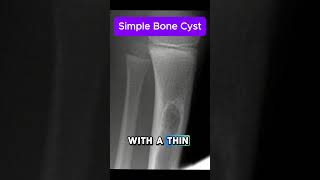 simple bone cysts [upl. by Oicnedif133]