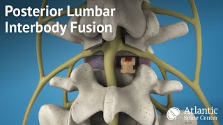 Posterior Lumbar Interbody Fusion PLIF [upl. by Okomot]