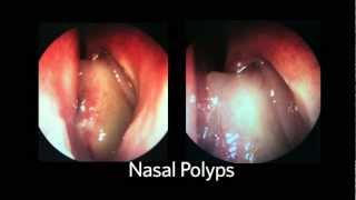 AAOHNSF The ENT Exam Episode 4 The Nasopharynx and Larynx Exam [upl. by Fatma940]