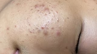 ACNE TREATMENT VU QUYNH MI  Perennial Blackheads On Boy Face 2024FULL [upl. by Alletneuq]