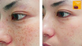 Amazing Freckles Removing Homemade Solution  100 Results [upl. by Scoles]