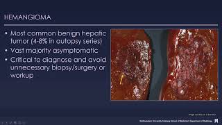 Imaging findings in liver lesions [upl. by Seda]