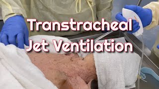 Transtracheal Jet Ventilation in a Cadaver Model [upl. by Liza]