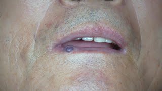 Pyogenic Granuloma on lip Removal Surgery HD 노인 남성의 입술에 생긴 화농성 육아종 혈관종 제거 수술 수원 광교 유디트 성형외과 [upl. by Grimes]