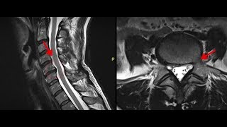 Bulging Discs Causes and Treatment [upl. by Danielson]