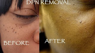 DPN Removal  Dermatosis Papulosa Nigra [upl. by Evan564]