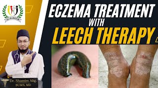 How to Cure Eczema Skin Disease Permanently By Unani medicine eczema leechtherapy [upl. by Affra]