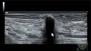 Significado das sombras acústicas intensas na ultrassonografia mamária [upl. by Eneladgam]