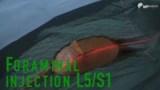 Foramnial injection for L5S1 vertebra [upl. by Jada617]