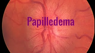 Papilledema A Swollen optic disc [upl. by Luana]