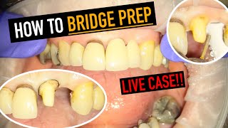 CLINICAL PROCEDURES IN DENTAL BRIDGE CONSTRUCTION [upl. by Materi]