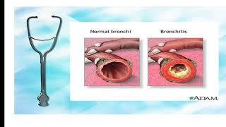 The Asthma disorder by Himani Sharma [upl. by Cornew609]