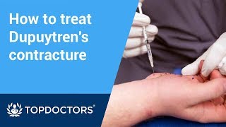 How collagenase injections treat Dupuytren’s contracture [upl. by Merceer]