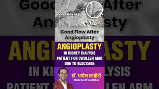 Central Venous Angioplasty Swelling of Dialysis Arm in Kidney Disease Patient healthshorts ytshort [upl. by Ernesta152]