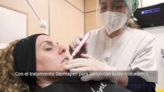 Tratamiento con Dermapen para labios con ácido hialurónico [upl. by Khalin116]