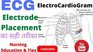 ECG ElectroCardiaGram ECG placement ECG ChestLead proper wayHow to Place ECG electrodeHindi me [upl. by Zephan281]