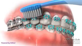 Proper Brushing Technique  Braces [upl. by Lemaceon]