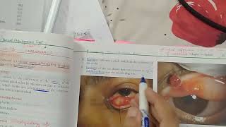 Chalazion  EYELIDS Lecture 1  Jatoi [upl. by Susan]