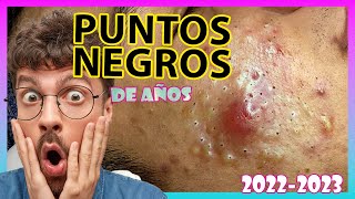 ⚠️ Granos y Espinillas Negras Gigantes que EXPLOTAN ¡Recopilatorio 2022⚠️ [upl. by Wilterdink]