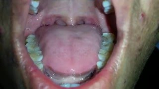 Tongue Fasciculation in MND [upl. by Leticia]