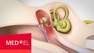 Conductive Hearing Loss Explained  MEDEL [upl. by Worden]