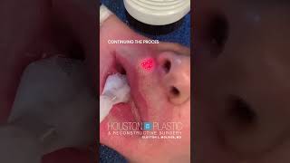 CO2 Laser treatment for heavy wrinkles around the mouth co2laser co2lasertreatment [upl. by Hamimej]