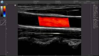 Carotide CFMmp4 [upl. by Neram]