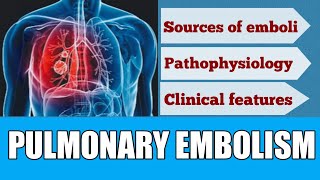 Pulmonary embolism  pathophysiology  sources of emboli factors associated with PE [upl. by Culosio784]