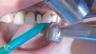 Bridge sectioning and premolar extraction [upl. by Bornie708]