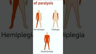 Types of Paralysis 🚨🚒notesviralvideotrensuperiormedical [upl. by Pascoe]