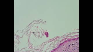 Histopathology of Lupus erythematosus [upl. by Itteb]