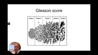 Prostate Cancer Grading and Staging [upl. by Crudden611]