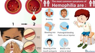 Hemophilia  Introduction Clinical Features Investigation and Management [upl. by Annohsat]