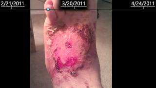 2nd Degree burns on foot  healing time lapse  2 months [upl. by Leahcim696]