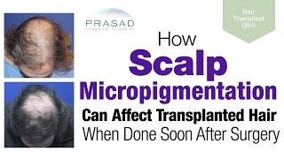 How Scalp Micropigmentation Too Soon after a Hair Transplant can Damage Hair Grafts [upl. by Marina]