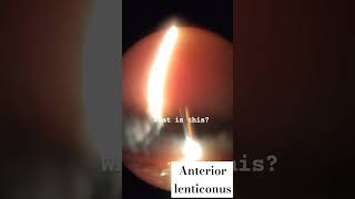 Anterior lenticonus shorts viral lens education optometry ophthalmologist eye [upl. by Ailecara]