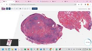 Epithelioid hemangioma aka angiolympoid hyperplasia with eosinophilALHE [upl. by Anirhtak]