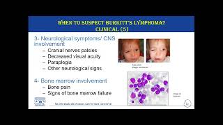 Diagnosis and Referral of Burkitt’s Lymphoma – 3 February 2023 [upl. by Ahsitam]