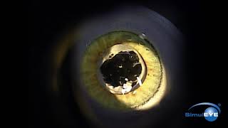 SimulEYE YAG Capsulotomy [upl. by Aiken543]