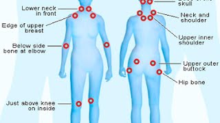 How To Diagnose Fibromyalgia [upl. by Wester]