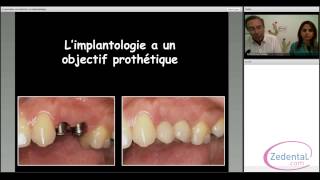 Commencer en Implantologie [upl. by Yarrum]